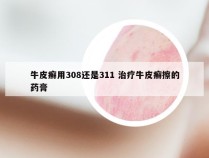 牛皮癣用308还是311 治疗牛皮癣擦的药膏