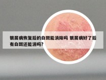 银屑病恢复后的白斑能消除吗 银屑病好了后有白斑还能消吗?