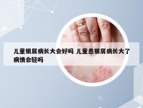 儿童银屑病长大会好吗 儿童患银屑病长大了病情会轻吗