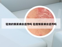 轻微的银屑病会遗传吗 轻度银屑病会遗传吗