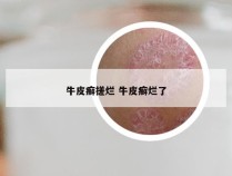 牛皮癣搓烂 牛皮癣烂了