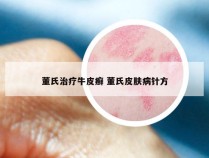 董氏治疗牛皮癣 董氏皮肤病针方