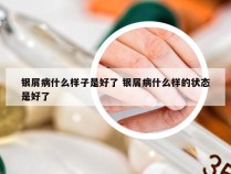 银屑病什么样子是好了 银屑病什么样的状态是好了
