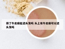 得了牛皮癣能烫头发吗 头上有牛皮癣可以烫头发吗
