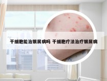 干细胞能治银屑病吗 干细胞疗法治疗银屑病
