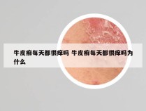 牛皮癣每天都很痒吗 牛皮癣每天都很痒吗为什么