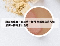 脂溢性皮炎与银屑病一样吗 脂溢性皮炎与银屑病一样吗怎么治疗