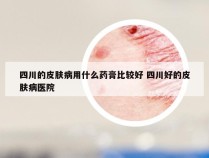 四川的皮肤病用什么药膏比较好 四川好的皮肤病医院