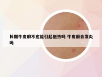 长期牛皮癣不愈能引起低热吗 牛皮癣会发炎吗