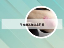 牛皮癣怎样防止扩散