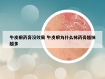 牛皮癣药膏没效果 牛皮癣为什么抹药膏越抹越多