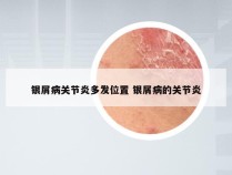 银屑病关节炎多发位置 银屑病的关节炎