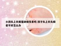 小孩头上长癣是缺维生素吗 孩子头上长头癣老不好怎么办