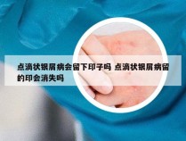 点滴状银屑病会留下印子吗 点滴状银屑病留的印会消失吗