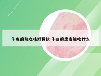 牛皮癣能吃啥好得快 牛皮癣患者能吃什么