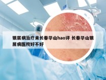银屑病治疗来长春华山hao评 长春华山银屑病医院好不好