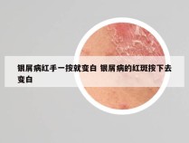 银屑病红手一按就变白 银屑病的红斑按下去变白