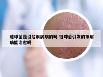 链球菌是引起银屑病的吗 链球菌引发的银屑病能治愈吗