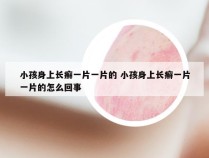 小孩身上长癣一片一片的 小孩身上长癣一片一片的怎么回事
