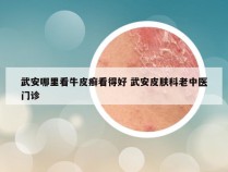 武安哪里看牛皮癣看得好 武安皮肤科老中医门诊