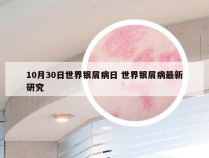 10月30日世界银屑病日 世界银屑病最新研究