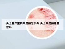 头上有严重的牛皮癣怎么办 头上牛皮癣能自愈吗