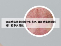 银屑病生物制剂打针打多久 银屑病生物制剂打针打多久见效