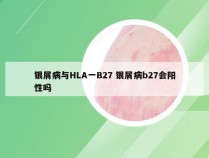 银屑病与HLA一B27 银屑病b27会阳性吗