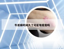 牛皮癣时间久了可能有癌变吗