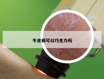 牛皮癣可以巧克力吗