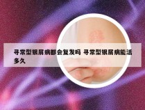 寻常型银屑病都会复发吗 寻常型银屑病能活多久