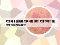 天津哪个医院看皮肤科比较好 天津市哪个医院看皮肤专科最好