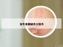 治牛皮癣秘方十验方