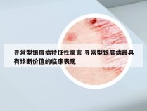 寻常型银屑病特征性损害 寻常型银屑病最具有诊断价值的临床表现