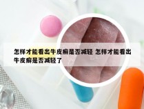 怎样才能看出牛皮癣是否减轻 怎样才能看出牛皮癣是否减轻了