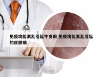 免疫功能紊乱引起牛皮癣 免疫功能紊乱引起的皮肤病