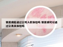 银屑病能通过公司入职体检吗 银屑病可以通过公务员体检吗