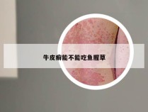 牛皮癣能不能吃鱼腥草
