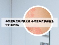 寻常型牛皮癣好转反应 寻常性牛皮肤癣有治好的案例吗?