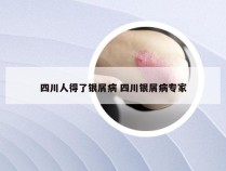 四川人得了银屑病 四川银屑病专家