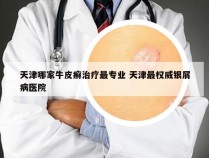 天津哪家牛皮癣治疗最专业 天津最权威银屑病医院