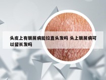 头皮上有银屑病能拉直头发吗 头上银屑病可以留长发吗