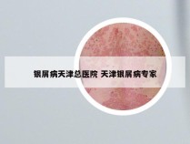 银屑病天津总医院 天津银屑病专家