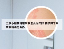 五岁小朋友得银屑病怎么治疗好 孩子得了银屑病我该怎么办