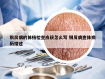 银屑病的体格检查应该怎么写 银屑病查体病历描述