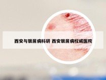 西安与银屑病科研 西安银屑病权威医院