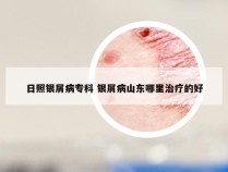 日照银屑病专科 银屑病山东哪里治疗的好