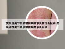 类风湿关节炎和银屑病关节炎有什么区别 类风湿性关节炎和银屑病关节炎区别