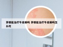 茅根能治疗牛皮癣吗 茅根能治疗牛皮癣吗怎么吃