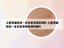 儿童得扁桃体一定会复发银屑病吗 儿童得扁桃体一定会复发银屑病吗图片